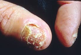 nail fungus.jpg